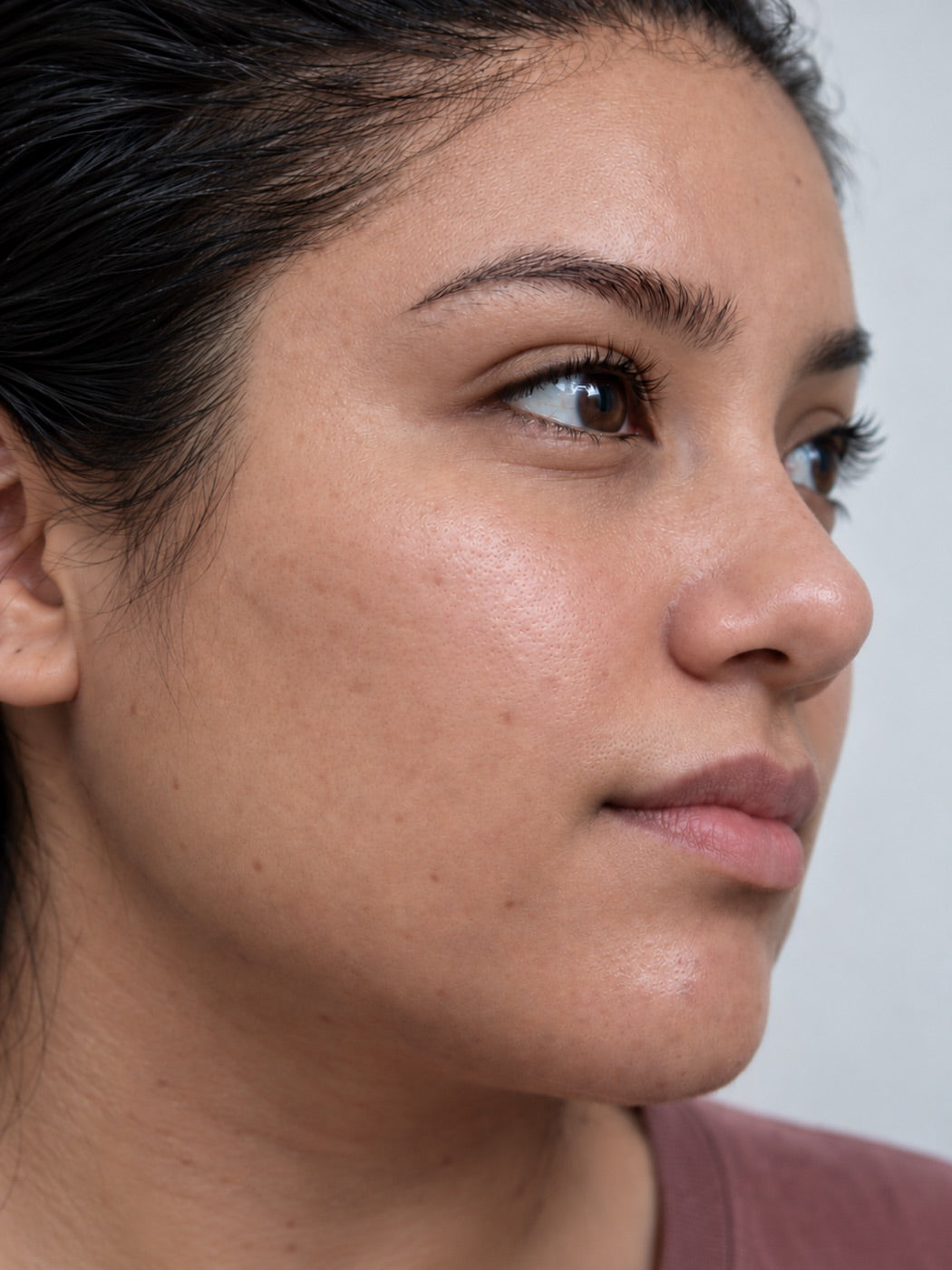 Post-acne marks & tone