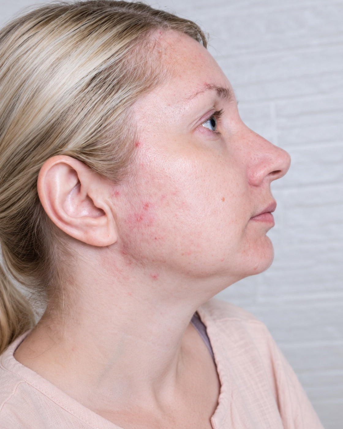 Redness & breakouts